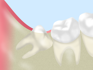 親知らずの抜歯について