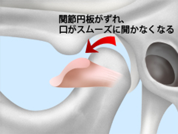 顎関節症について